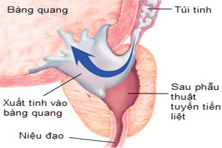 Xuất tinh ngược dòng - Hình ảnh minh họa